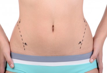 Liposuction: Your Guide To Body Contouring