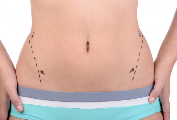 Liposuction: Your Guide To Body Contouring
