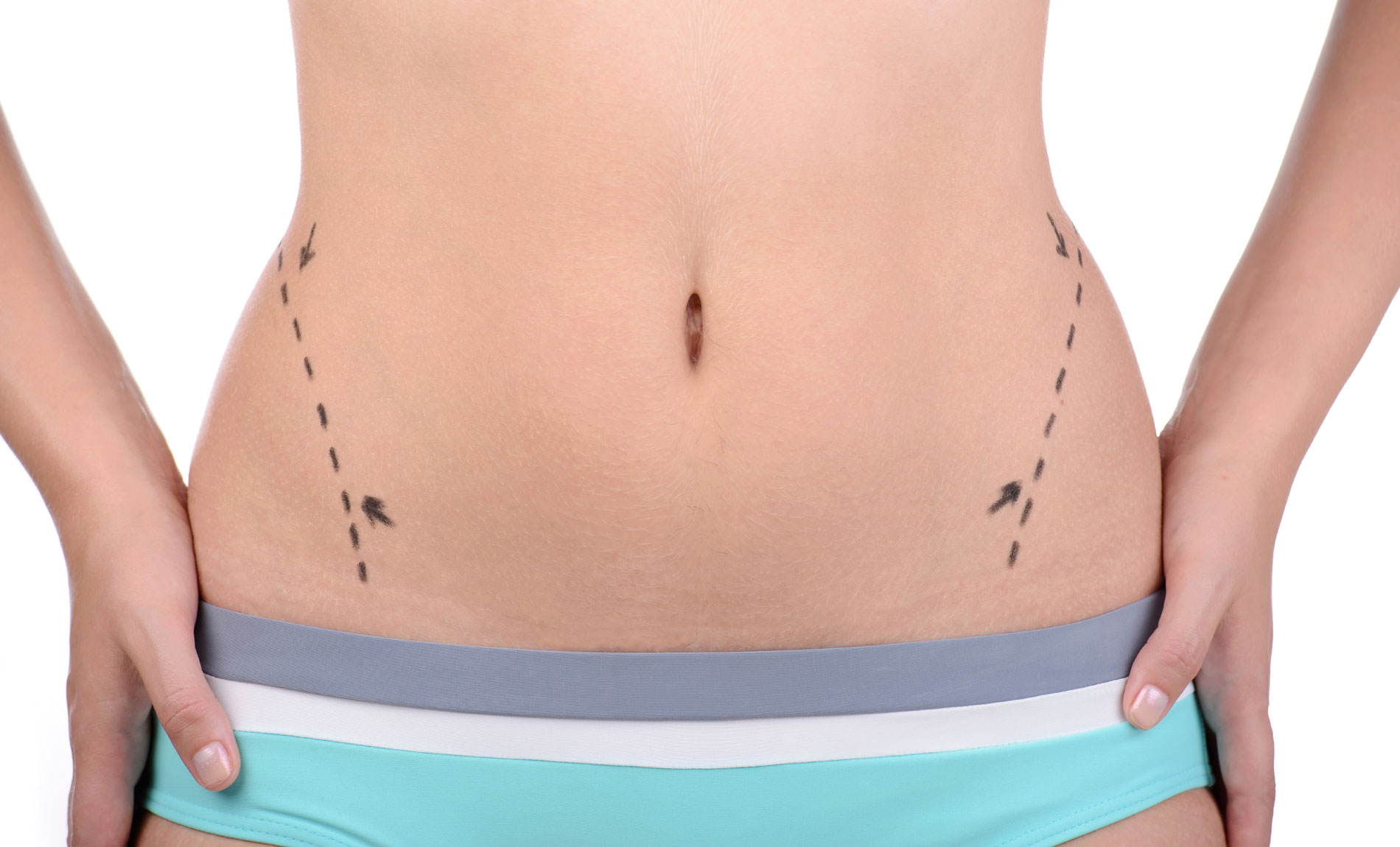 Liposuction: Your Guide To Body Contouring