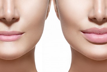 Lip Augmentation: What's Involved in Plumping Your Pout