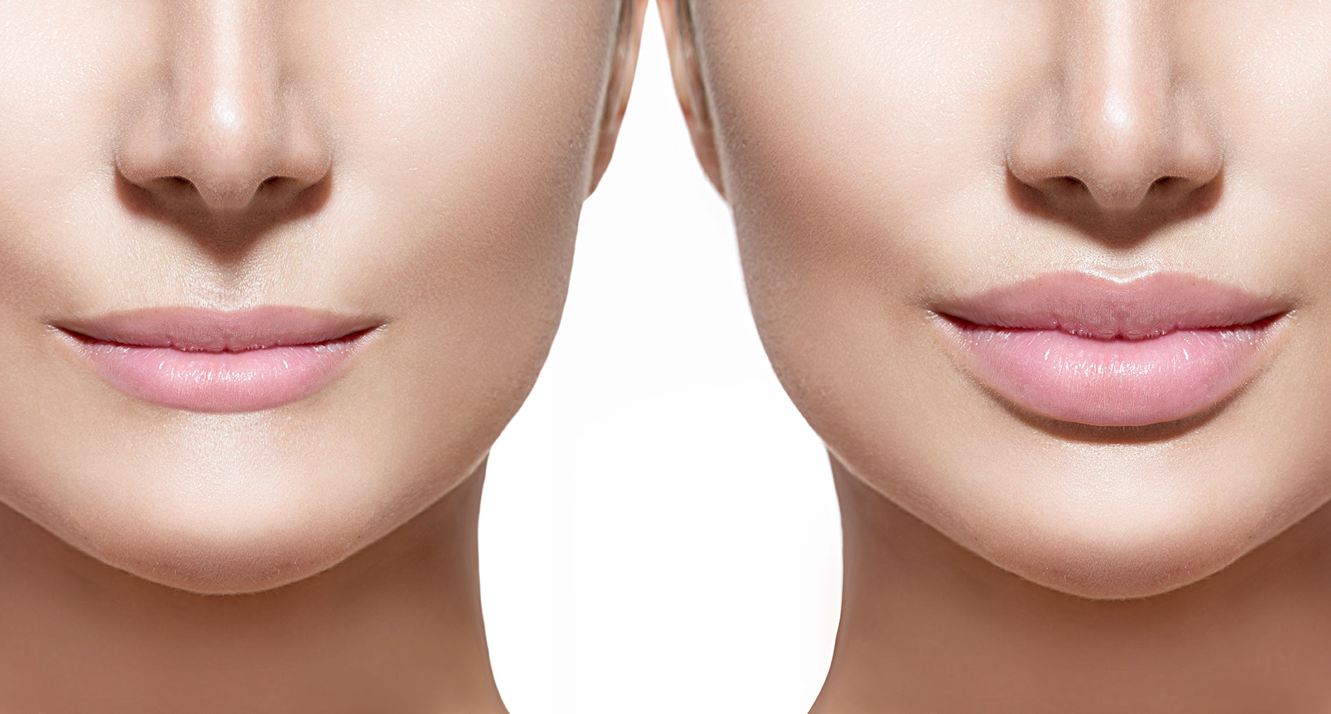 Lip Augmentation: What's Involved in Plumping Your Pout