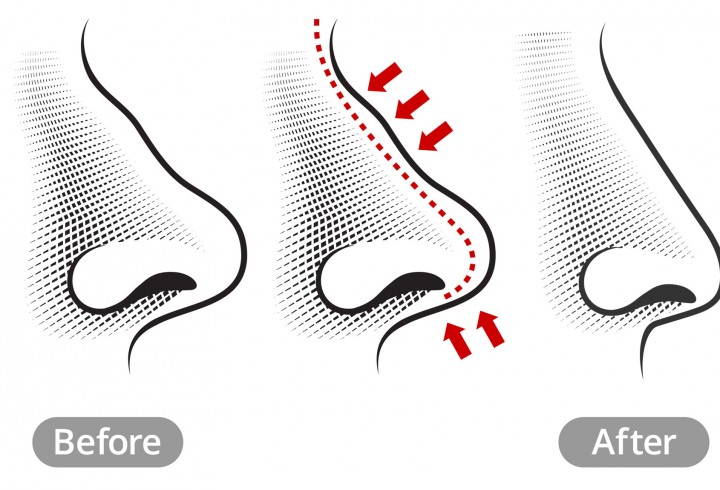 Rhinoplasty: Everything You Need to Know