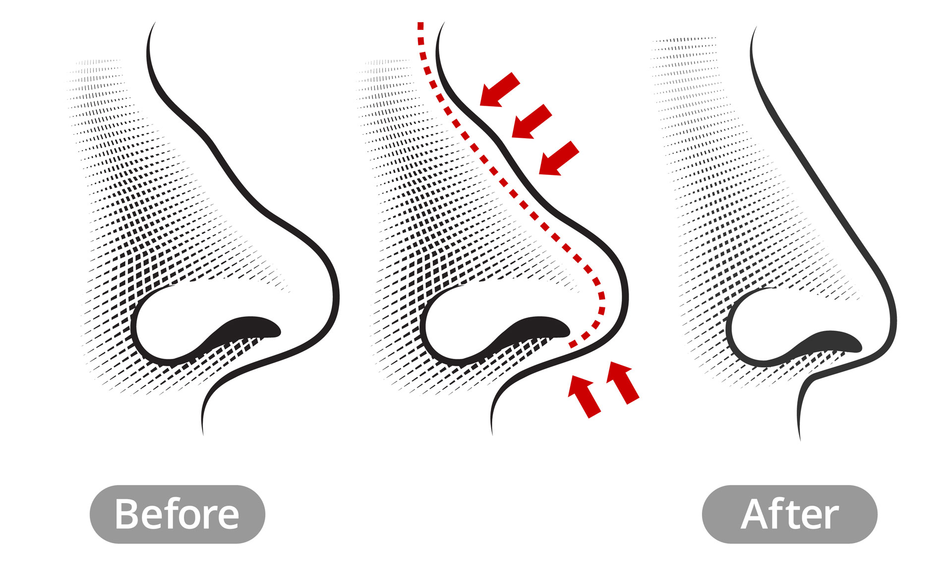 Rhinoplasty: Everything You Need to Know