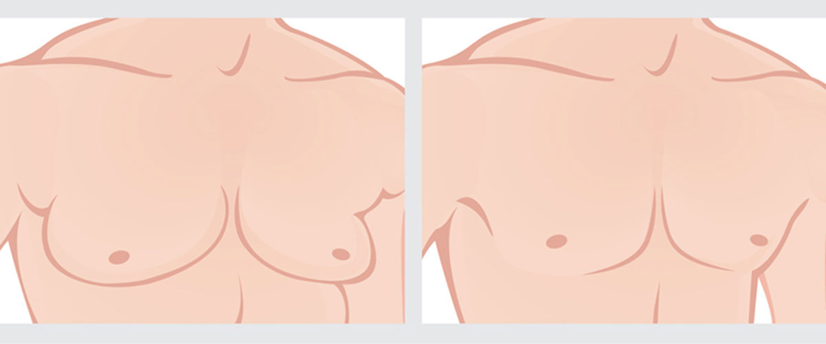 Gynecomastia-An-overview-121615-02