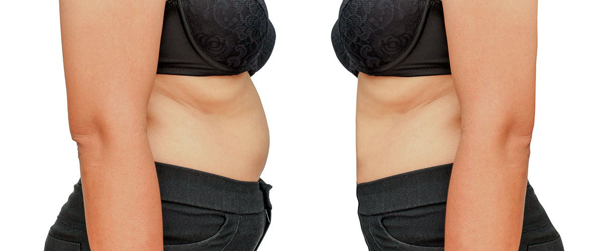 LIPOSUCTION-Everything-you-need-to-know-about this-type-of-contouring-121615-01