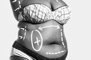 LIPOSUCTION-Everything-you-need-to-know-about this-type-of-contouring-121615-12