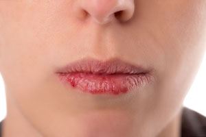 Lip-Augmentation-121615-04