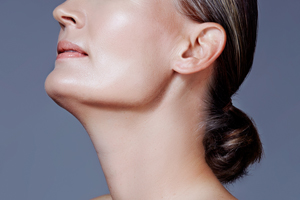 Neck-Lift-121615-05