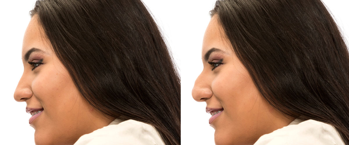 Rhinoplasty-Everything-you-need-to-know-121516-04