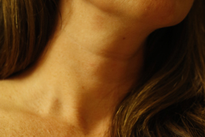 Neck-Lift-Costs-5