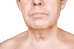 Neck-Lift-Costs-6