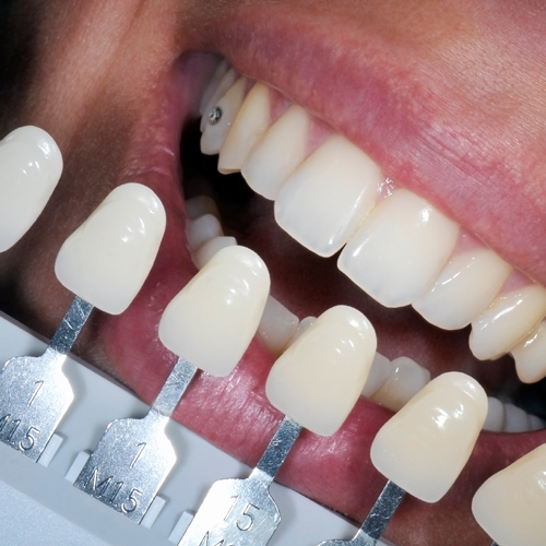 Teeth-Whitening-2