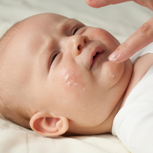 Things-You-Can-Do-To-Fight-Eczema-In-Kids-5